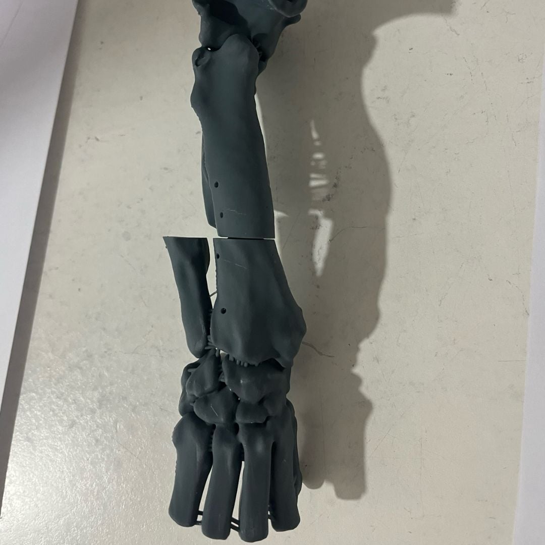 Case Study: Angular Limb Deformity Correction Case Study: Angular Limb Deformity Correction